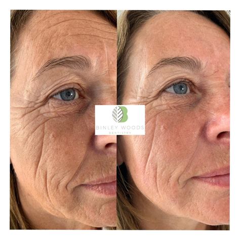 hydrafacial reviews for older skin.